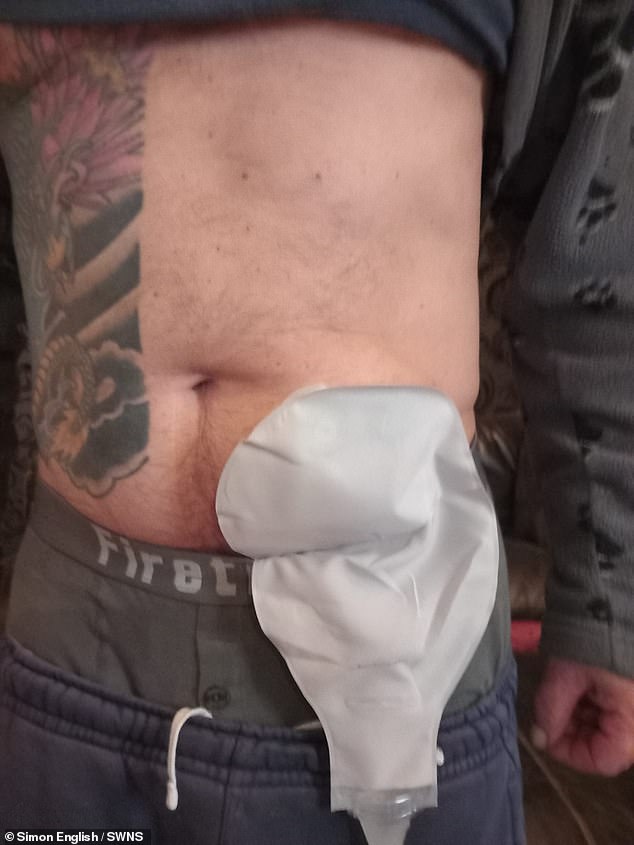 Mr English was fitted with a colostomy bag, in which one end of the colon is diverted through an opening in the abdomen. The waste products are then collected in a bag attached to the opening.