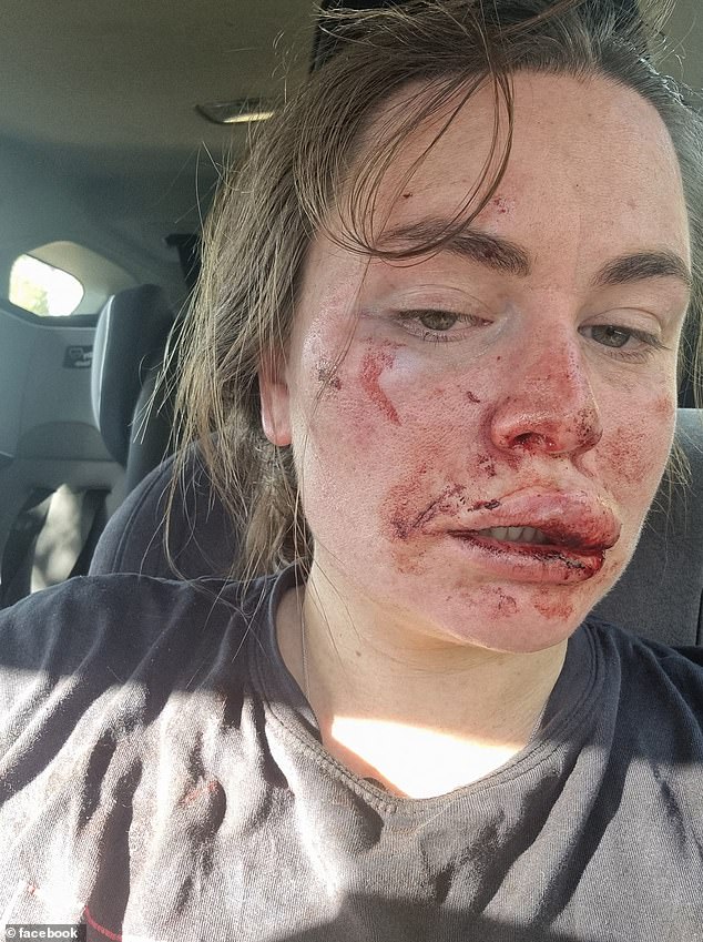 Sissy Austin posted photos of herself after last year's attack by a man armed with a rock tied to a stick.