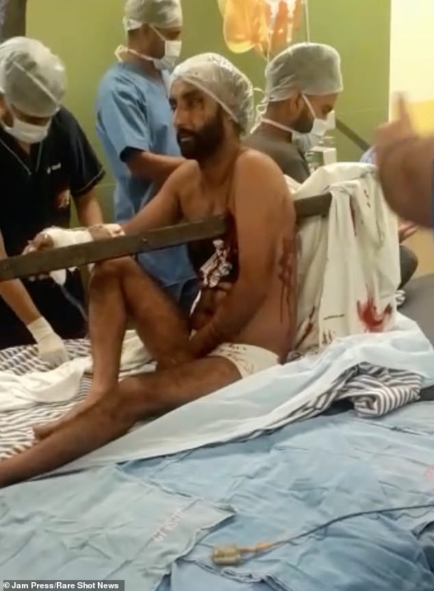 A CT scan found that Hardeep suffered a broken rib and broken scapula, but incredibly the rod missed all of his vital organs.