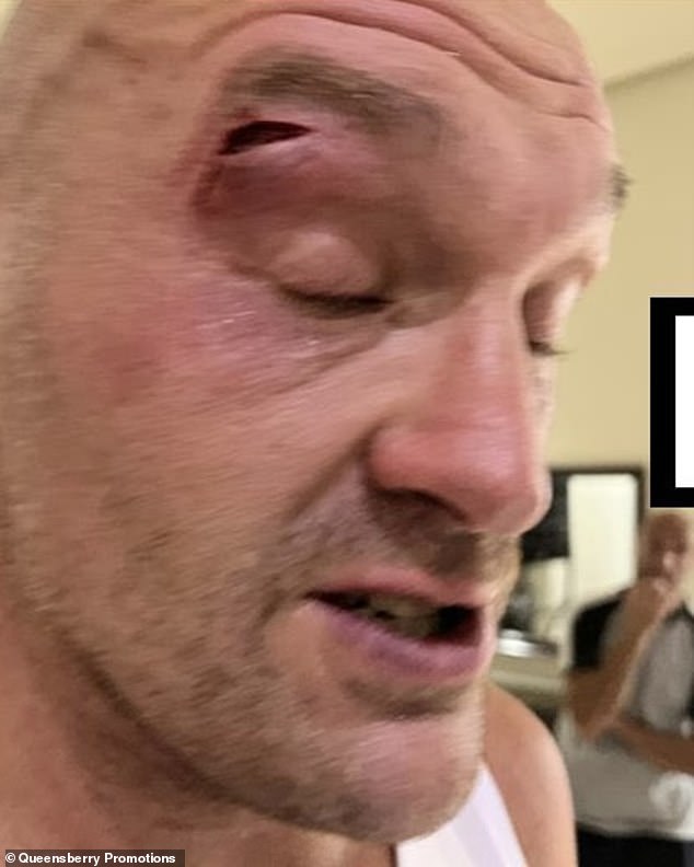 This is the nasty laceration over Tyson Fury's right eye that postponed his next fight