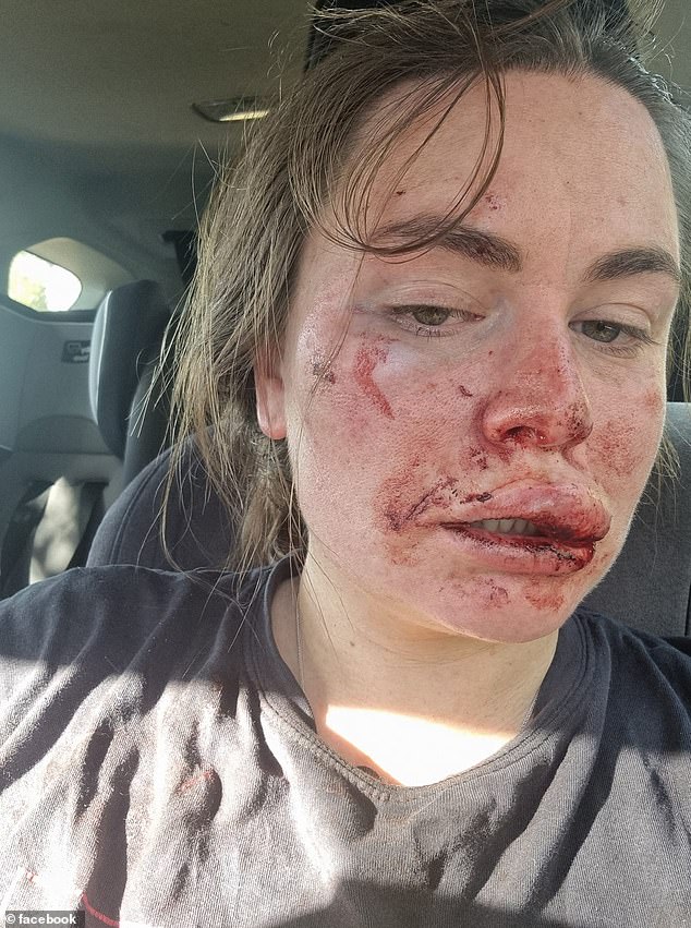 Sissy Austin posted photos of herself before and after last year's attack by a man armed with a rock tied to a stick.