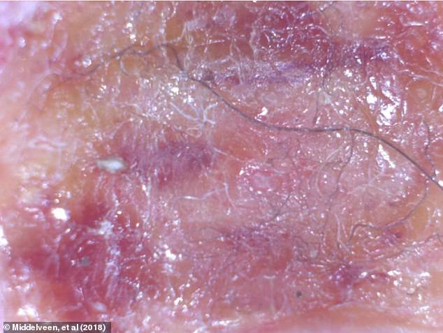 The enlarged photo above shows blue and white filaments embedded in the skin from a 2018 study.