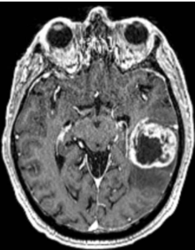 The median survival time for glioblastoma is 12 to 18 months: only 25 percent of patients survive more than one year and only five percent of patients survive more than five years. The black mass in the upper right corner is glioblastoma.
