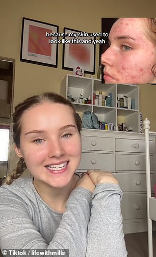 TikTok user and nutrition student @lifewithmils shows her face when she has acne