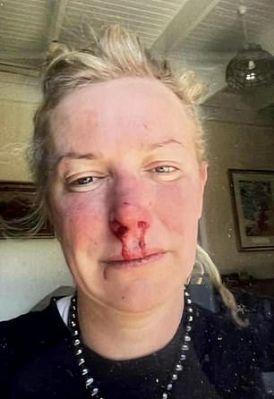 Buttrose shared images of his bloody nose and chin on social media.