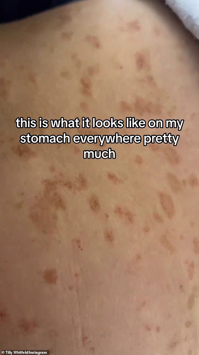 'I had implants five weeks ago and I've had this rash ever since. I went to the dermatologist and the hospital and they put me on two different steroids,” she began. 'It just clears up and then comes right back. I would appreciate any advice'