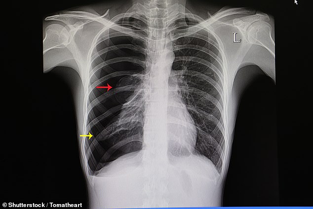 Also shown is a chest x-ray of a patient with a large pneumothorax with almost complete collapse of the right lung (yellow arrow), a lung blister, a small accumulation of air between the lung and the outer surface of the lung (red arrow) (stock image )