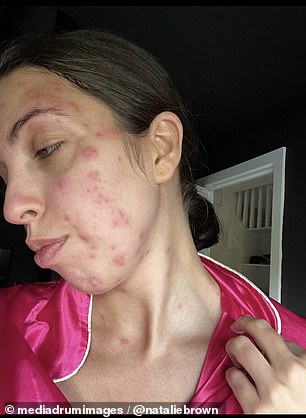 Natalie Brown (pictured), 28, was left covered in bedbug bites after spending three days on holiday in Benidorm, Spain.