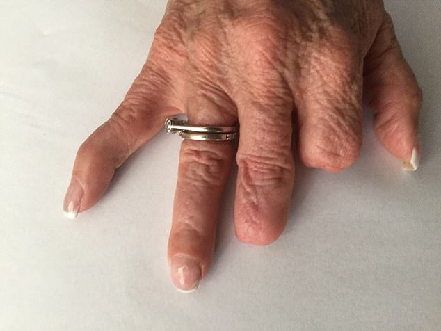A 62-year-old British woman who lived in Spain tells how her fingers had to be amputated after suffering septic shock