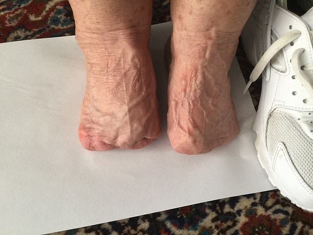 A British expat, who has now returned to the UK, had part of her feet amputated after her skin began to peel. 