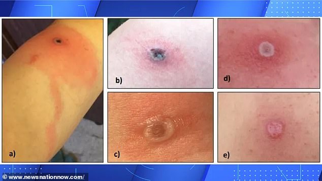 Health officials recommend covering any skin lesions that develop and avoiding touching the sore. The immunocompromised man first saw a red lump in his armpit in September 2023 and was prescribed antibiotic treatments after visiting A&E.