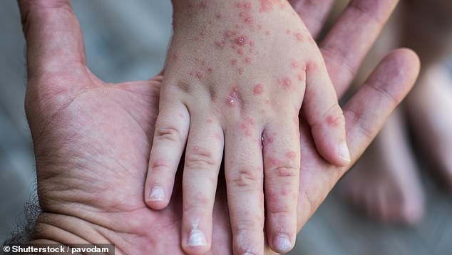Measles causes a rash and fever and can trigger serious health complications. It is very contagious and can be fatal (file image)