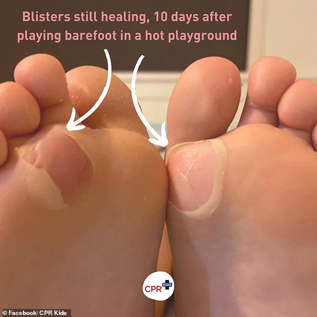 Parents are warned about the dangers of their local playground as the mercury begins to rise, especially if they let their children play without shoes - pictured healing burns
