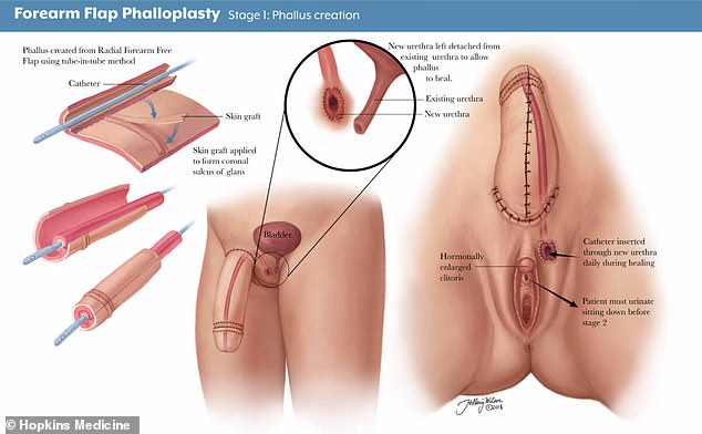 A phalloplasty procedure, as described in a medical textbook.
