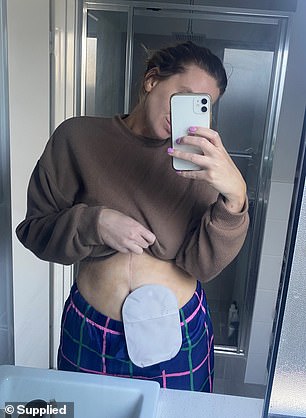 On December 1, Kate had a major five-hour operation to remove tumors from her ovaries and reconstruct her bowel, leaving her with an ileostomy stoma bag.