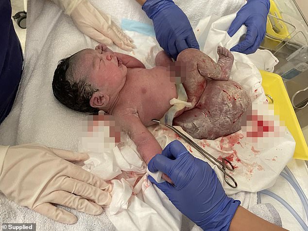 Once she gave birth, the baby was immediately rushed to an operating room for a gruesome six-hour surgery to remove the teratoma.