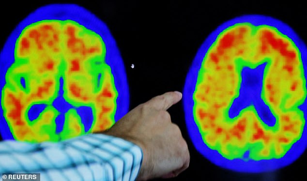Experts have warned that people taking these drugs actually lose brain volume, putting the approval of these treatments in the UK at risk (file image)