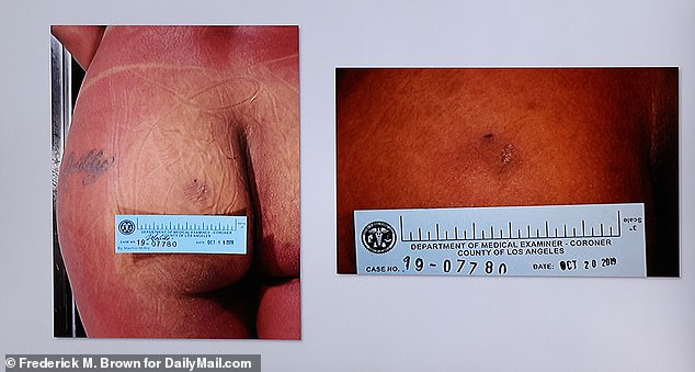 A series of lurid images of Brazilian butt lifts gone wrong were shown as the trial began on Tuesday.