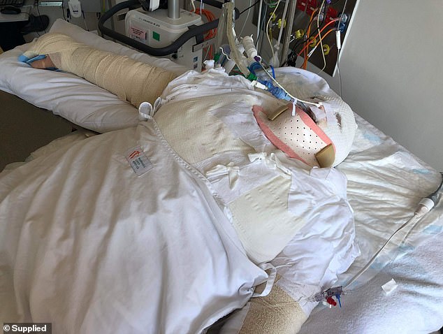 He suffered severe burns to the upper half of his body, including his lungs, and has been in an induced coma since (pictured).