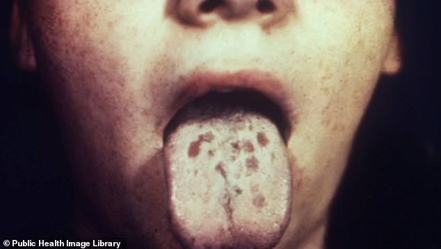 Diseases such as syphilis (pictured) and gonorrhea were once death sentences, but with the introduction of penicillin as a medicine in the 1940s, they became easily treatable.