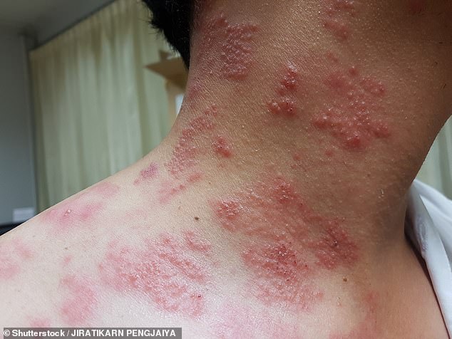 While it is not usually serious if detected as chickenpox at a young age, the virus can potentially reactivate later in life as shingles and appear as a red rash with blistering spots.