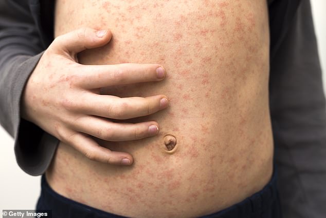 Measles is a highly contagious virus that is transmitted through the air and mainly affects children under five years of age.