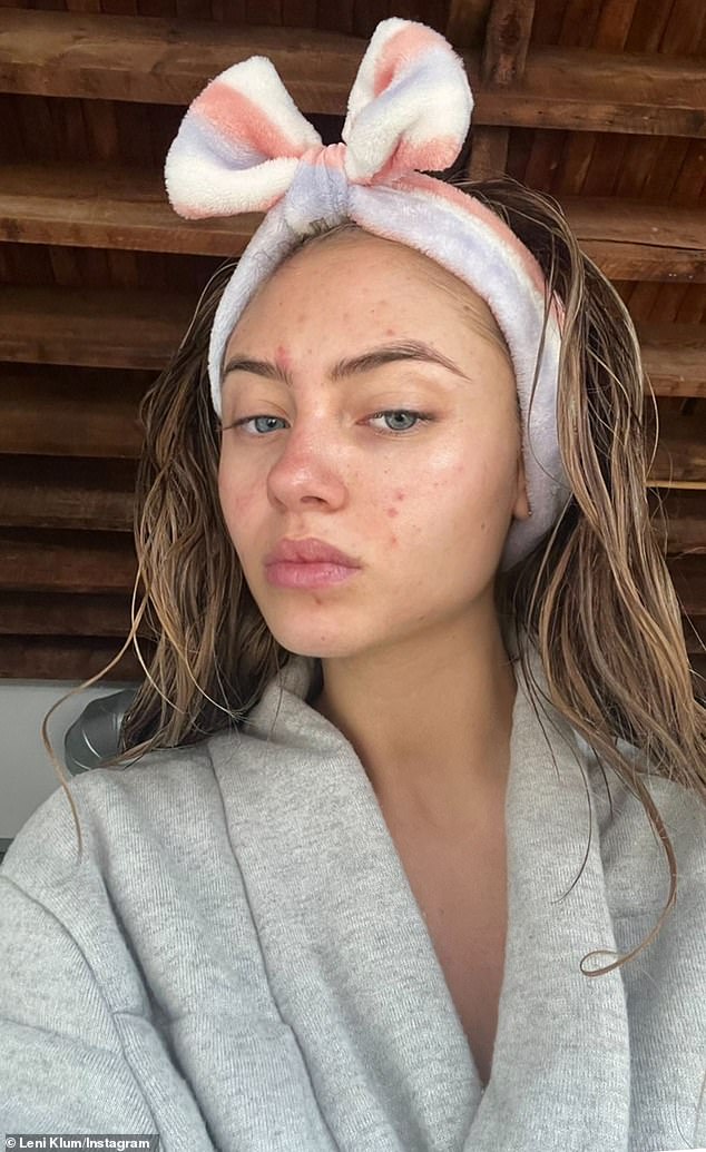 Leni has shared a series of close-up photos showing off her breakouts in recent years to combat the stigma of acne.