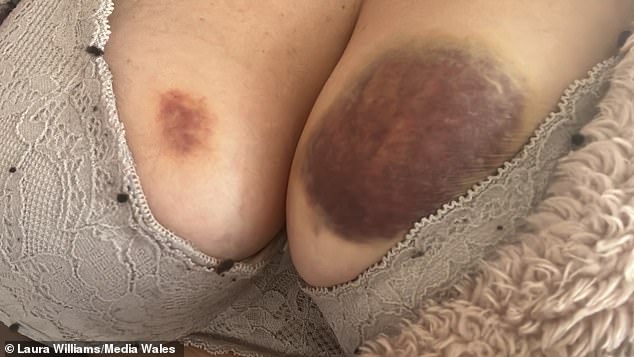 Thomas bit her left breast and laughed when she told him to get off. Her shocking injuries are seen here.