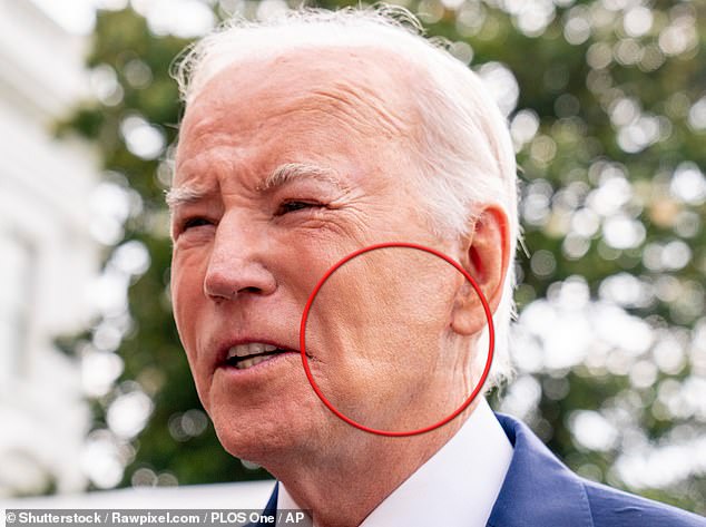 Biden was photographed last year with a mark on his face that was later revealed to have been caused by wearing a mask to treat his sleep apnea.