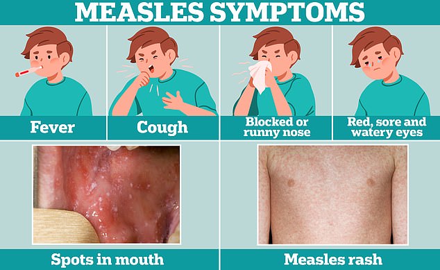 Cold-like symptoms, such as fever, cough, and runny or stuffy nose, are often the first sign of measles. A few days later, some people develop small white spots on the inside of their cheeks and on the back of their lips. The telltale measles rash also develops, usually starting on the face and behind the ears, before spreading to the rest of the body.