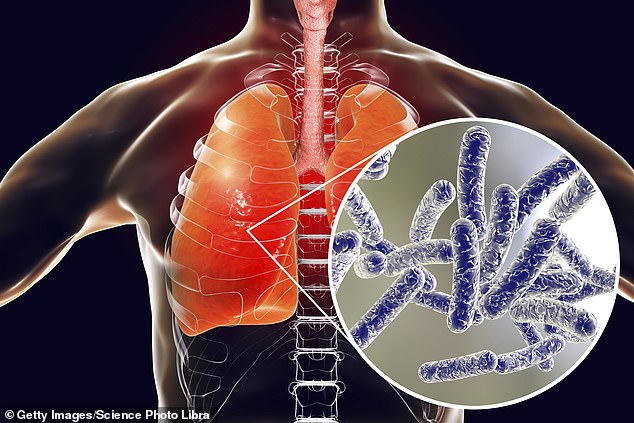 Legionnaires' disease is a severe form of pneumonia caused by the Legionella bacteria.