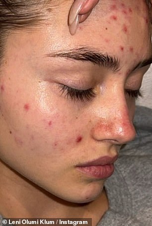 Leni took to her Instagram to shed light on her struggle with acne, as she shared a candid makeup-free selfie with her 1.9 million Instagram followers.