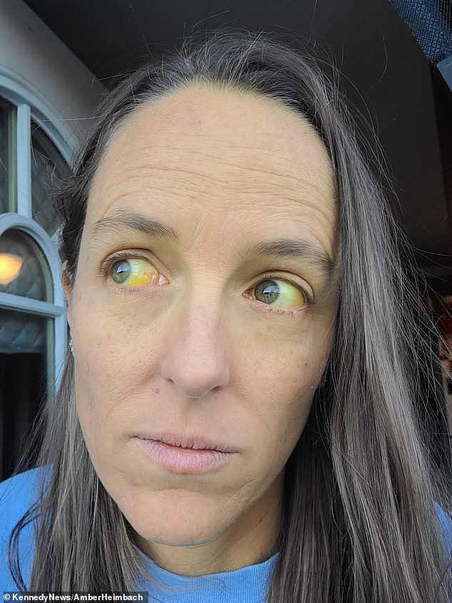The 39-year-old mother of four developed yellowish skin and eyes two months after she started taking an herbal supplement to combat menopause symptoms.