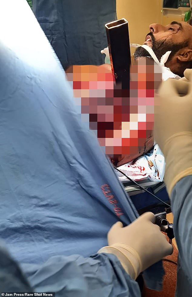 Hardeep underwent a four-and-a-half-hour operation to remove the rod from his chest.