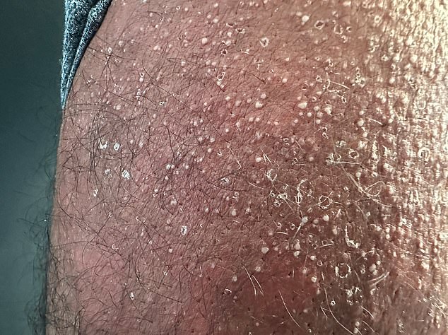 The 40-year-old man developed pustules (small bumps on the skin containing fluid or pus) covering his chest, face and thighs after taking tadalafil, sold as Cialis in the UK.  In the photo, pustules on the thigh.