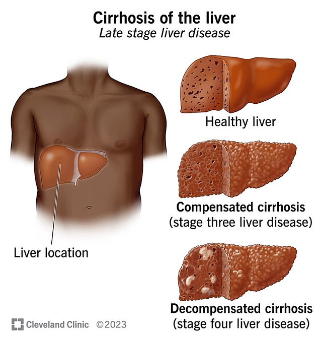 The chart above shows the location of the liver and what a healthy liver looks like compared to one with cirrhosis or liver scarring.