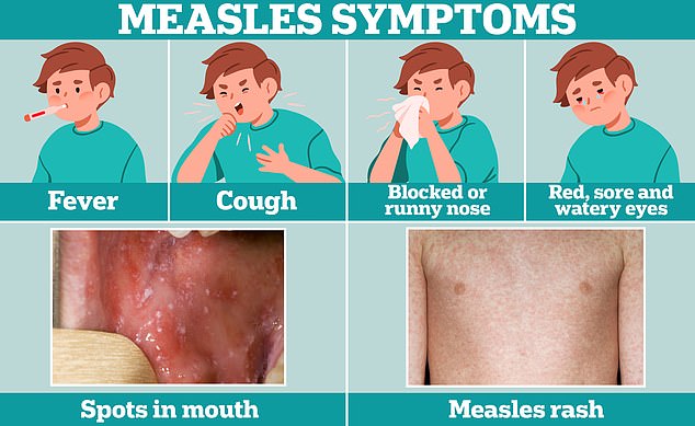 Cold-like symptoms, such as fever, cough, and runny or stuffy nose, are often the first sign of measles.  A few days later, some people develop small white spots on the inside of their cheeks and on the back of their lips.  The telltale measles rash also develops, usually starting on the face and behind the ears, before spreading to the rest of the body.