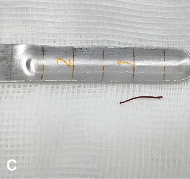 The photo above shows the part of the acupuncture needle that was removed during surgery.  The family said it had been lodged in his brain for two decades.
