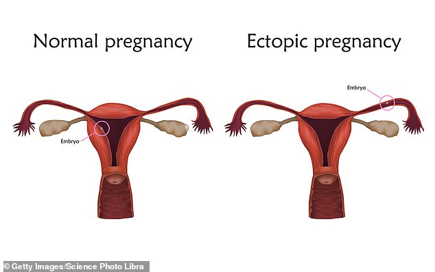 An ectopic pregnancy, in which the fertilized egg implants outside the uterus, almost always results in pregnancy loss because the embryo cannot develop properly in these locations.