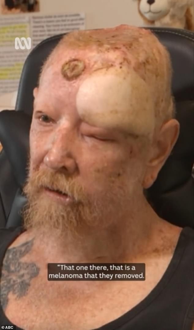 He has had nearly 200 skin cancers removed from his body, four of which were melanomas, leading to chemotherapy sessions and numerous skull surgeries.