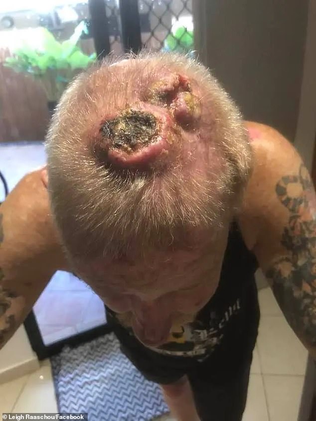 He has lost parts of his skull to cancer.