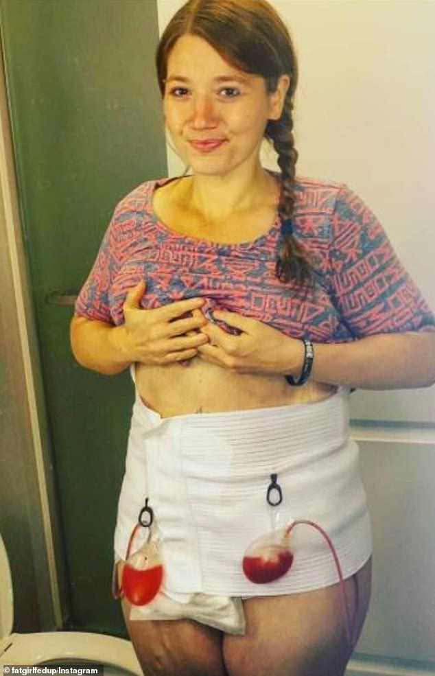 In 2018, she underwent a nine-hour surgery to remove seven pounds of excess skin from her body with the intention of having more removed in the future.