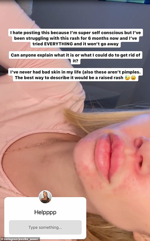 The Australian reality star took to Instagram Stories on Saturday with a close-up video of her chin and the top of her mouth covered in a painful-looking red rash.