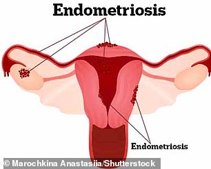 Endometriosis is a condition where tissue similar to the lining of the uterus grows elsewhere, including the ovaries, fallopian tubes and bowel