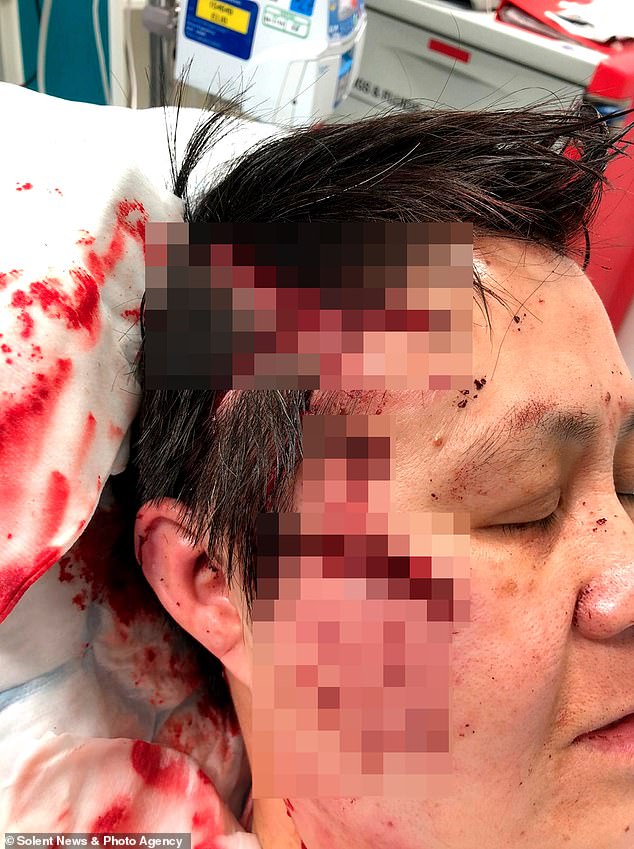 Shue suffered horrific injuries to his face and was left in a 'pool of blood' after the attack
