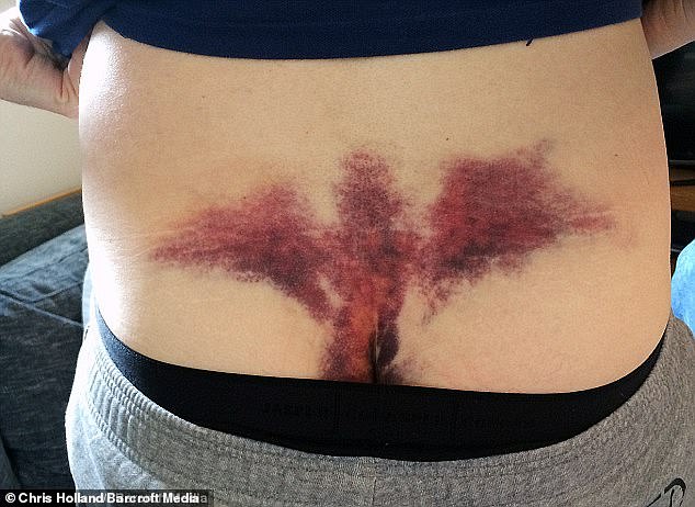 Chris Holland suffered an angel-shaped bruise on his lower back after being injured during his bachelor party.