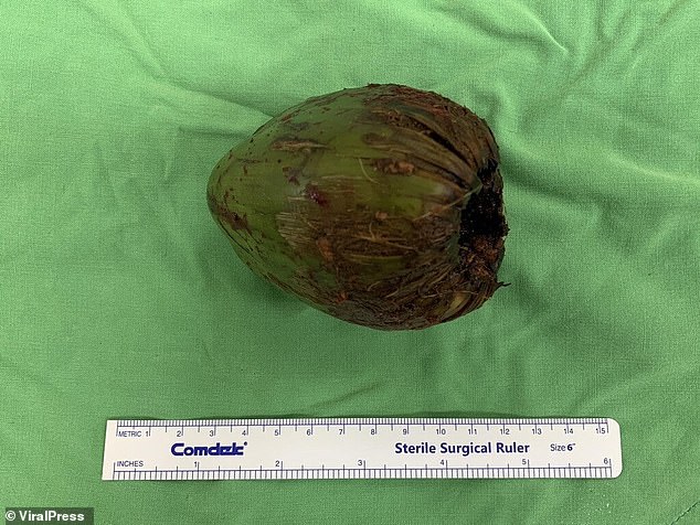 The date of the incident was not revealed in the doctor's report at E-Da Hospital in the southern city of Kaohsiung.  The coconut, measuring 9cm long, was then removed via laparotomy, an operation that involves opening the abdomen.