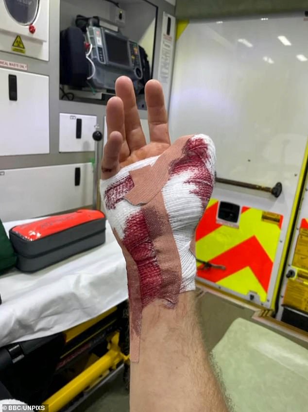 Mr Jenkinson was rushed to hospital on December 14, 2022 where he underwent an 11-hour operation during which part of his big toe was surgically stitched to the stump of his missing thumb.
