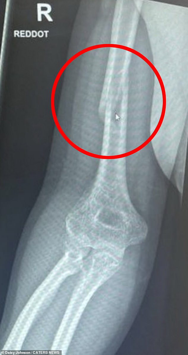 The 24-year-old suffered a spiral fracture of her humerus, a bone in the upper arm connected to the shoulder, and experienced extreme pain for the next few days.