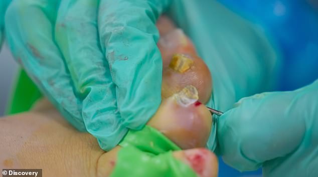 Stomach-aching images Craig receives fourteen numbing injections into his toes and seven nails are extracted